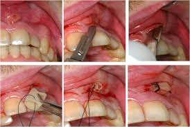 Vzroki za nastanek vnetja dlesni